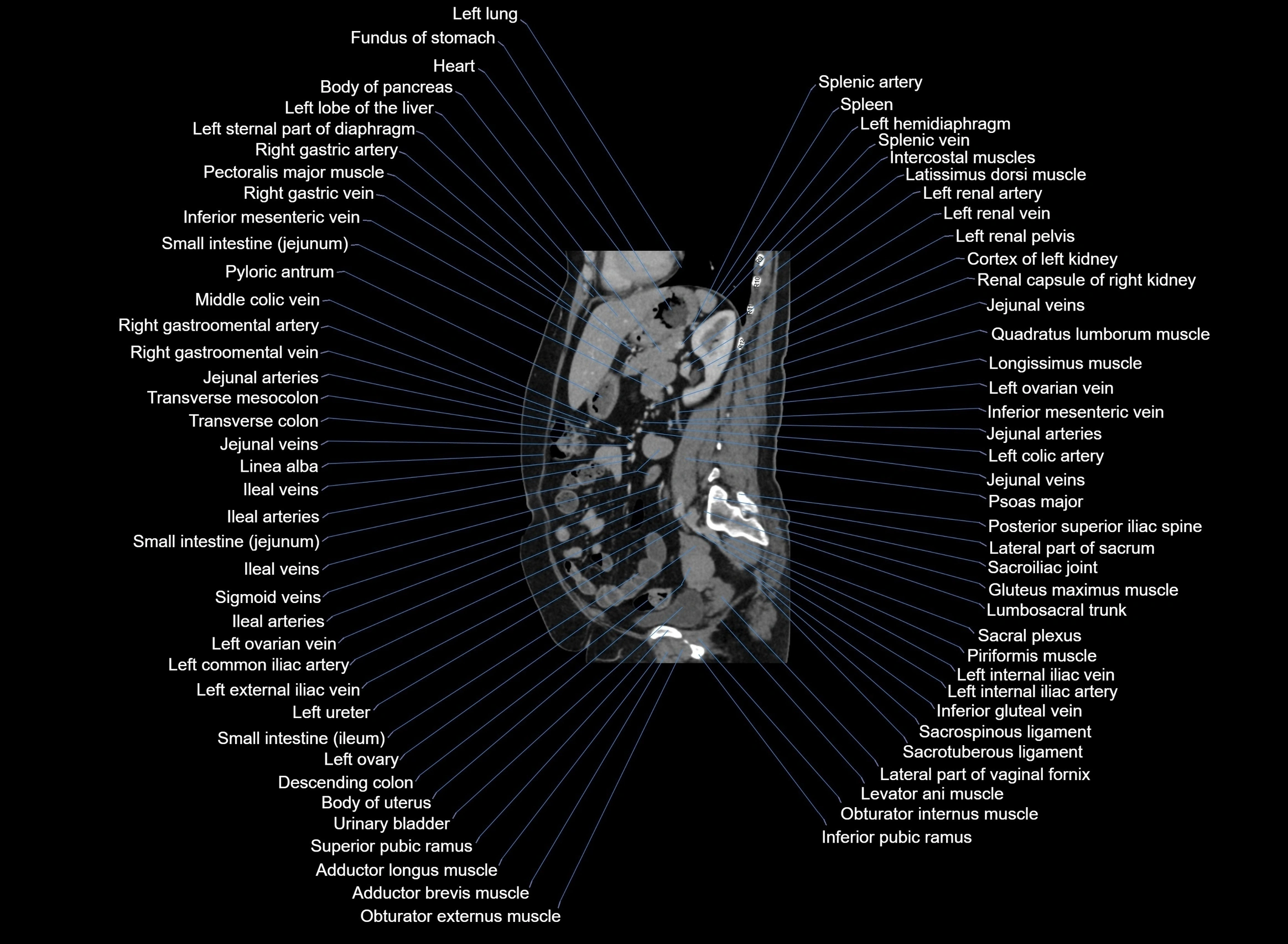 CT Abdomen sagittal cross sectional anatomy labelled radiology image -00047.webp